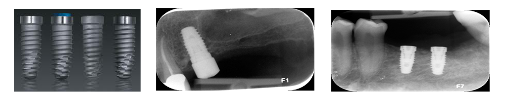 Implantologia dentale